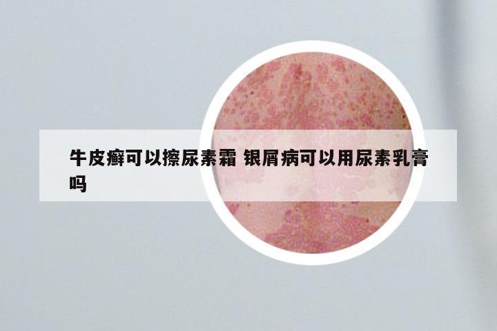 牛皮癣可以擦尿素霜 银屑病可以用尿素乳膏吗