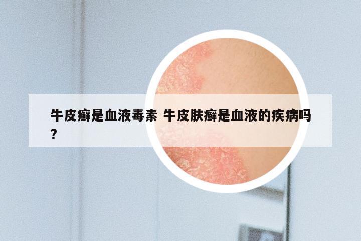 牛皮癣是血液毒素 牛皮肤癣是血液的疾病吗?