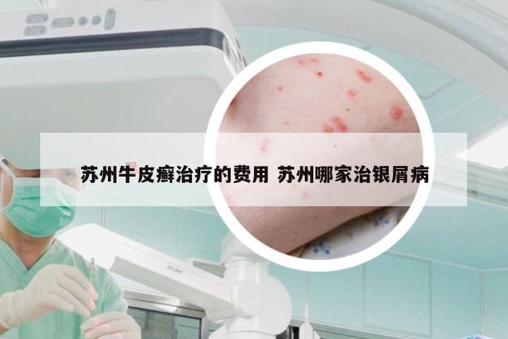苏州牛皮癣治疗的费用 苏州哪家治银屑病
