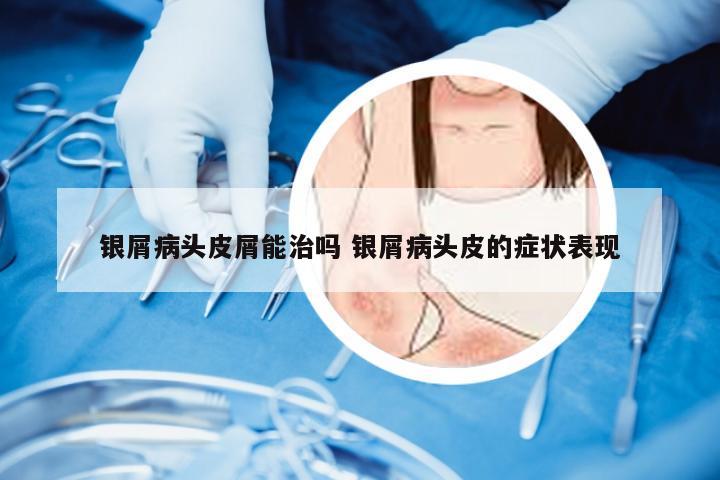 银屑病头皮屑能治吗 银屑病头皮的症状表现