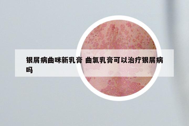 银屑病曲咪新乳膏 曲氯乳膏可以治疗银屑病吗
