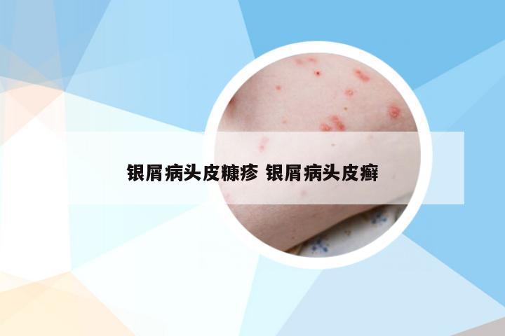 银屑病头皮糠疹 银屑病头皮癣
