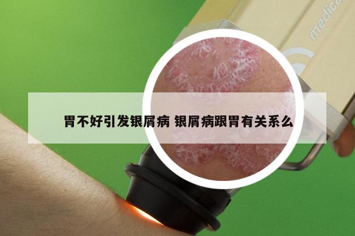 胃不好引发银屑病 银屑病跟胃有关系么