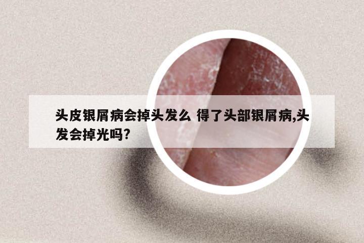 头皮银屑病会掉头发么 得了头部银屑病,头发会掉光吗?