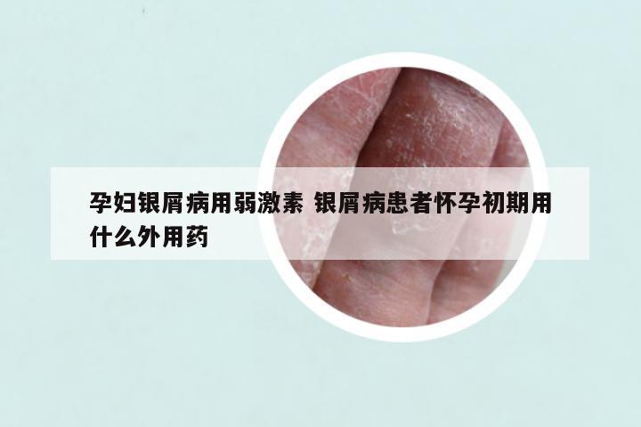 孕妇银屑病用弱激素 银屑病患者怀孕初期用什么外用药