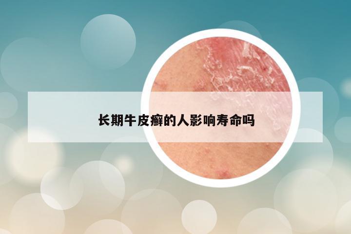 长期牛皮癣的人影响寿命吗