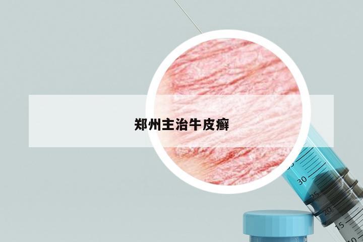 郑州主治牛皮癣