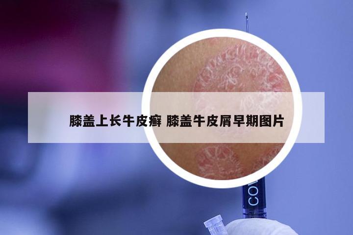 膝盖上长牛皮癣 膝盖牛皮屑早期图片