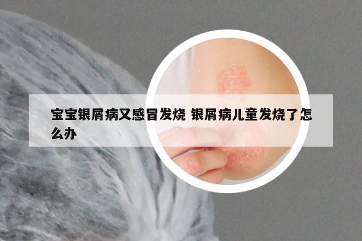 宝宝银屑病又感冒发烧 银屑病儿童发烧了怎么办