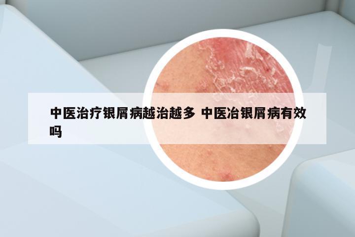 中医治疗银屑病越治越多 中医冶银屑病有效吗