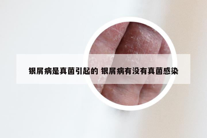银屑病是真菌引起的 银屑病有没有真菌感染