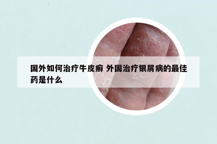 国外如何治疗牛皮癣 外国治疗银屑病的最佳药是什么