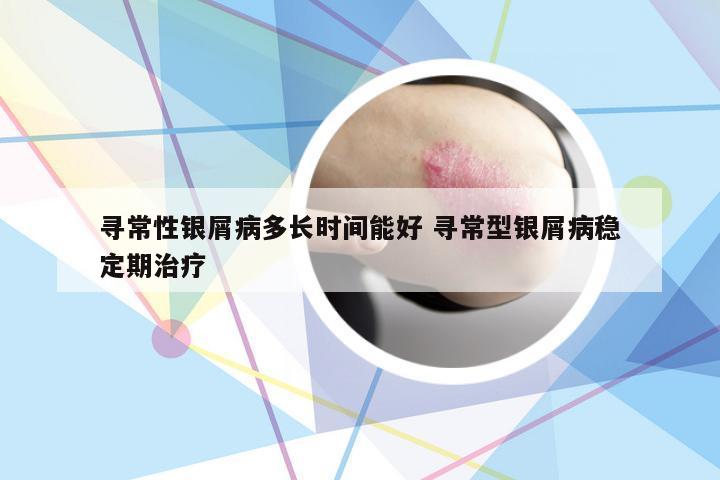 寻常性银屑病多长时间能好 寻常型银屑病稳定期治疗