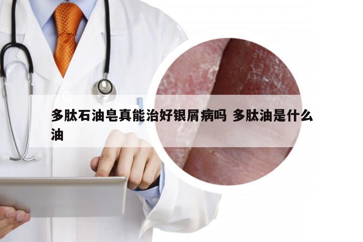 多肽石油皂真能治好银屑病吗 多肽油是什么油