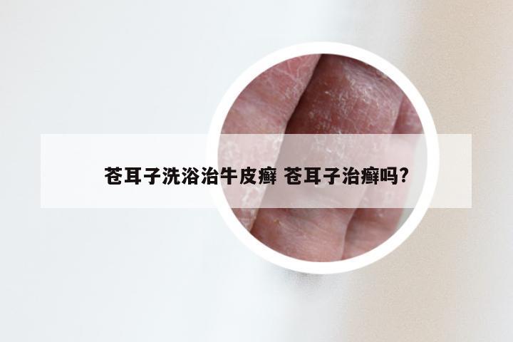 苍耳子洗浴治牛皮癣 苍耳子治癣吗?