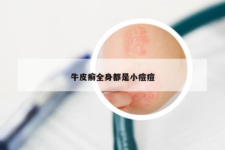 牛皮癣全身都是小痘痘