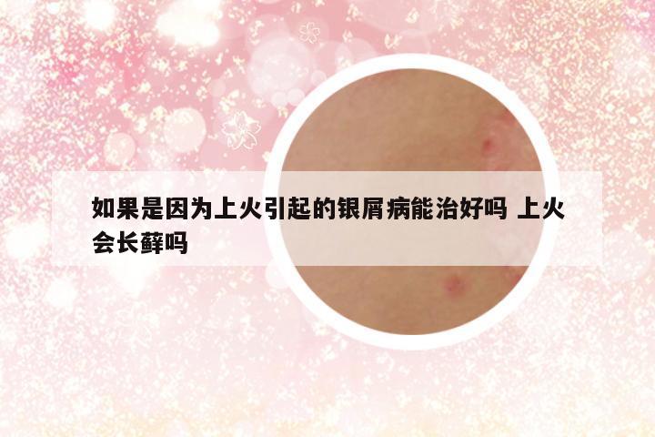 如果是因为上火引起的银屑病能治好吗 上火会长藓吗