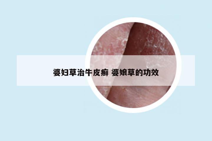 婆妇草治牛皮癣 婆娘草的功效