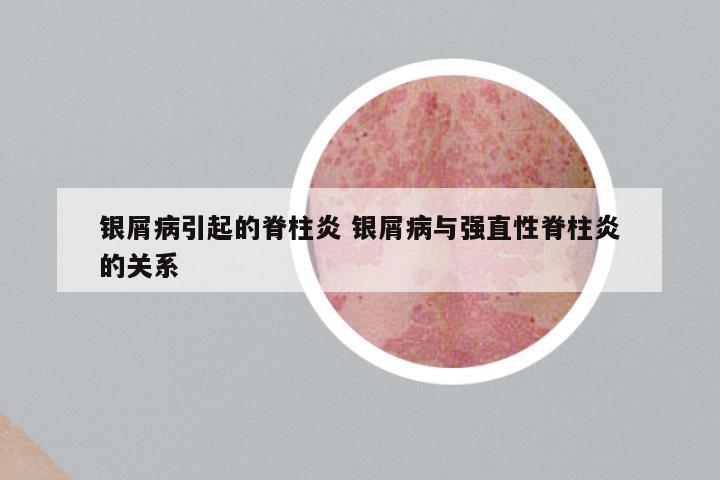 银屑病引起的脊柱炎 银屑病与强直性脊柱炎的关系