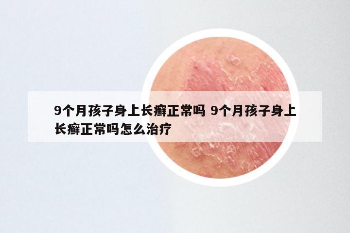 9个月孩子身上长癣正常吗 9个月孩子身上长癣正常吗怎么治疗