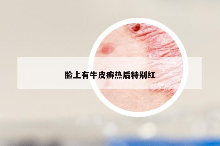 脸上有牛皮癣热后特别红