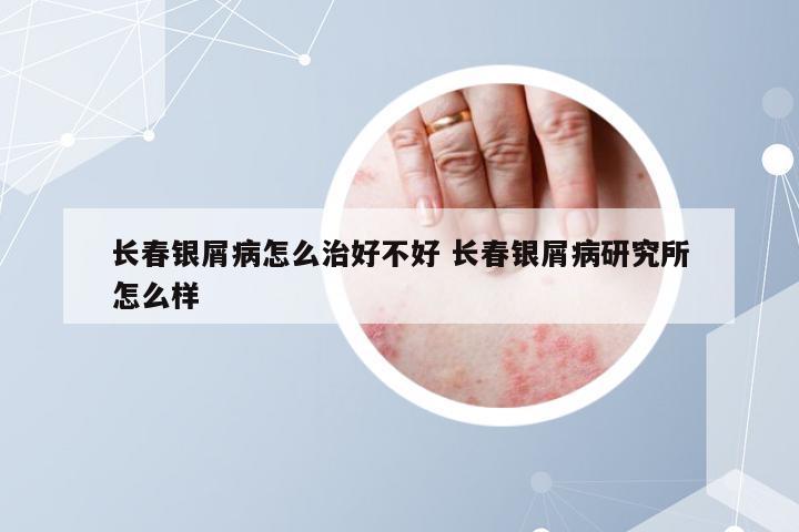 长春银屑病怎么治好不好 长春银屑病研究所怎么样