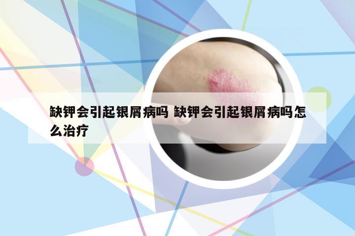 缺钾会引起银屑病吗 缺钾会引起银屑病吗怎么治疗