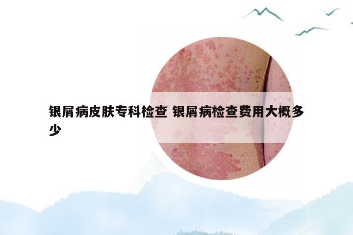 银屑病皮肤专科检查 银屑病检查费用大概多少