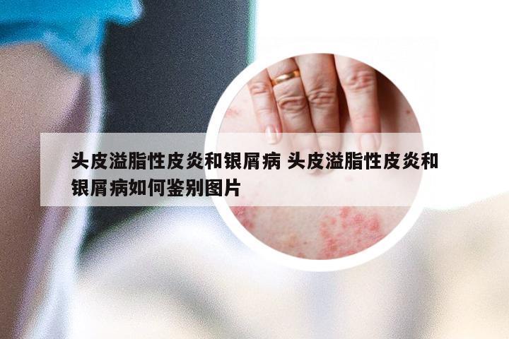 头皮溢脂性皮炎和银屑病 头皮溢脂性皮炎和银屑病如何鉴别图片
