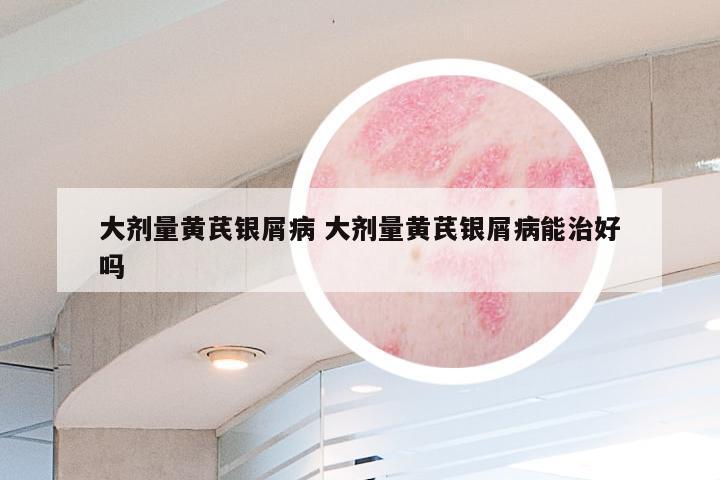 大剂量黄芪银屑病 大剂量黄芪银屑病能治好吗
