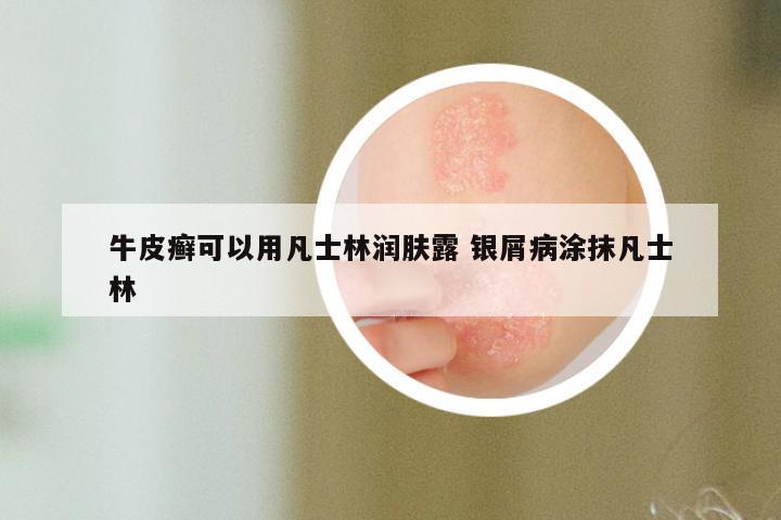 牛皮癣可以用凡士林润肤露 银屑病涂抹凡士林