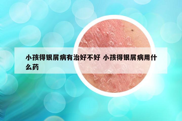 小孩得银屑病有治好不好 小孩得银屑病用什么药