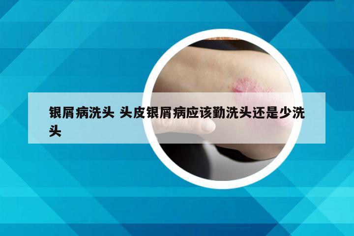 银屑病洗头 头皮银屑病应该勤洗头还是少洗头