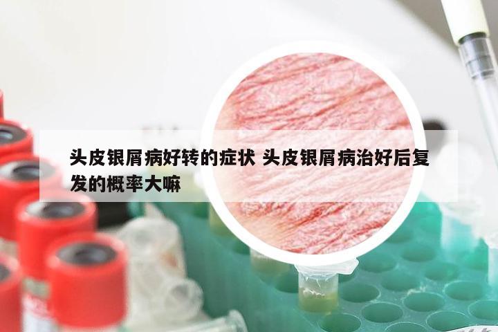 头皮银屑病好转的症状 头皮银屑病治好后复发的概率大嘛