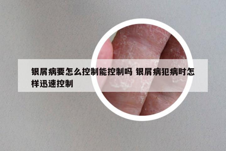 银屑病要怎么控制能控制吗 银屑病犯病时怎样迅速控制
