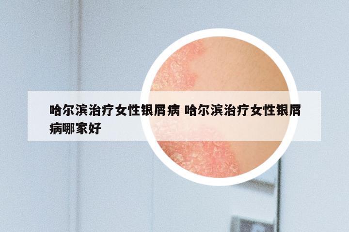 哈尔滨治疗女性银屑病 哈尔滨治疗女性银屑病哪家好