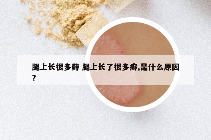 腿上长很多藓 腿上长了很多癣,是什么原因?