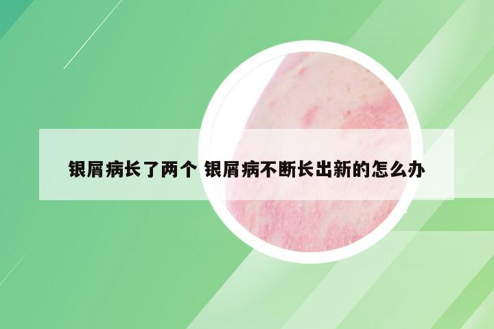 银屑病长了两个 银屑病不断长出新的怎么办