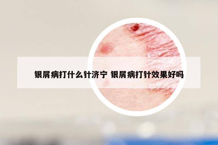 银屑病打什么针济宁 银屑病打针效果好吗