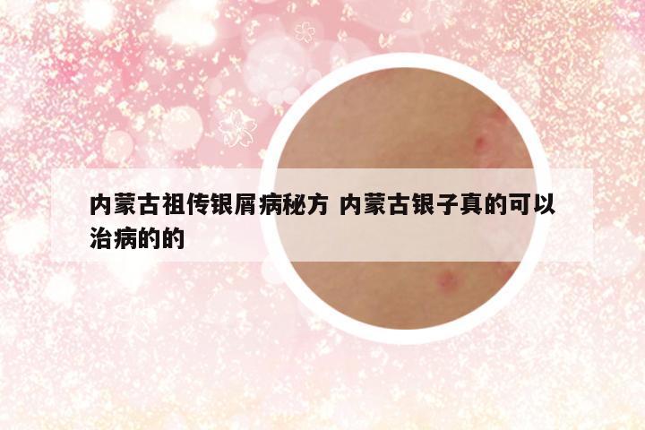 内蒙古祖传银屑病秘方 内蒙古银子真的可以治病的的