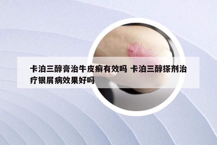 卡泊三醇膏治牛皮癣有效吗 卡泊三醇搽剂治疗银屑病效果好吗