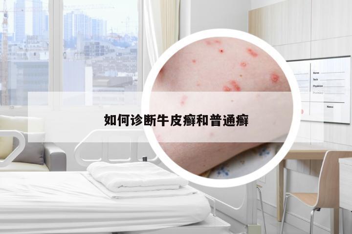 如何诊断牛皮癣和普通癣