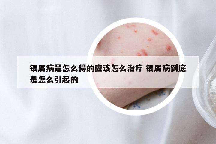 银屑病是怎么得的应该怎么治疗 银屑病到底是怎么引起的