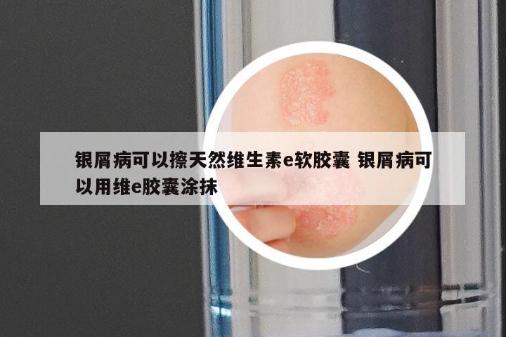 银屑病可以擦天然维生素e软胶囊 银屑病可以用维e胶囊涂抹