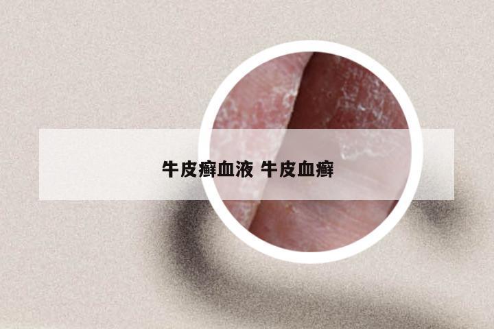 牛皮癣血液 牛皮血癣