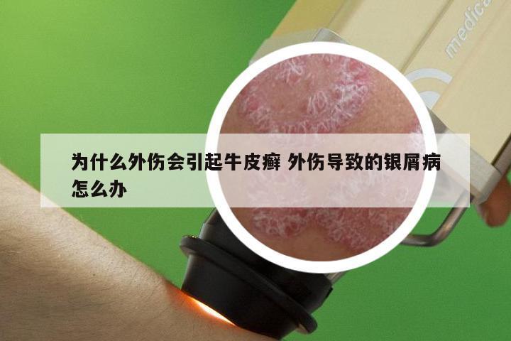 为什么外伤会引起牛皮癣 外伤导致的银屑病怎么办