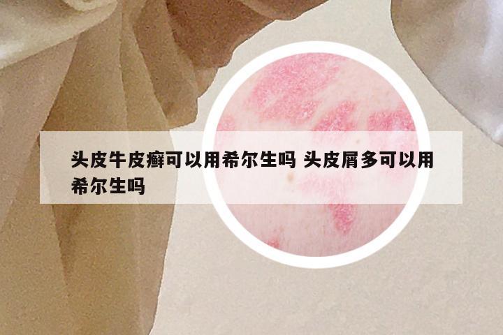 头皮牛皮癣可以用希尔生吗 头皮屑多可以用希尔生吗
