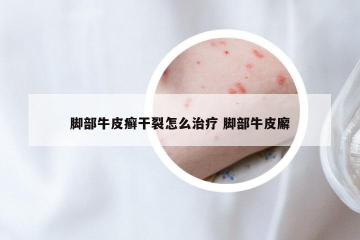 脚部牛皮癣干裂怎么治疗 脚部牛皮廨
