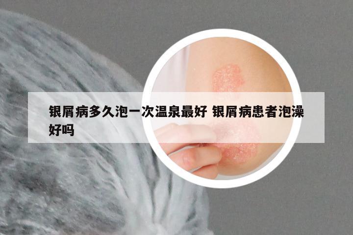 银屑病多久泡一次温泉最好 银屑病患者泡澡好吗