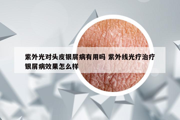 紫外光对头皮银屑病有用吗 紫外线光疗治疗银屑病效果怎么样